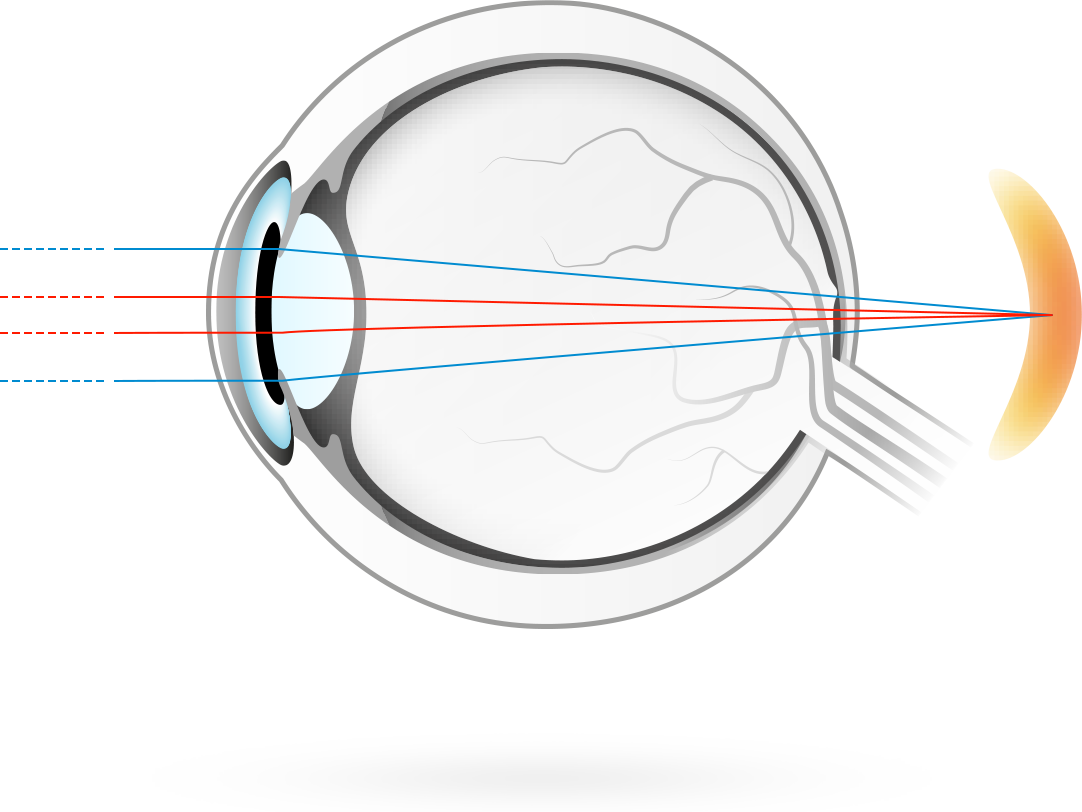 Langsynethed – en tilstand, hvor det optiske billede i øjet har sit fokus bag nethinden, hvorved det bliver vanskeligere for øjet at fokusere på objekter tæt ved
