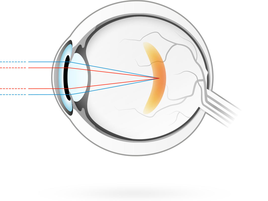 Nærsynethed – en tilstand, hvor det optiske billede i øjet har sit fokus foran nethinden, hvad der medfører et uklart afstandssyn