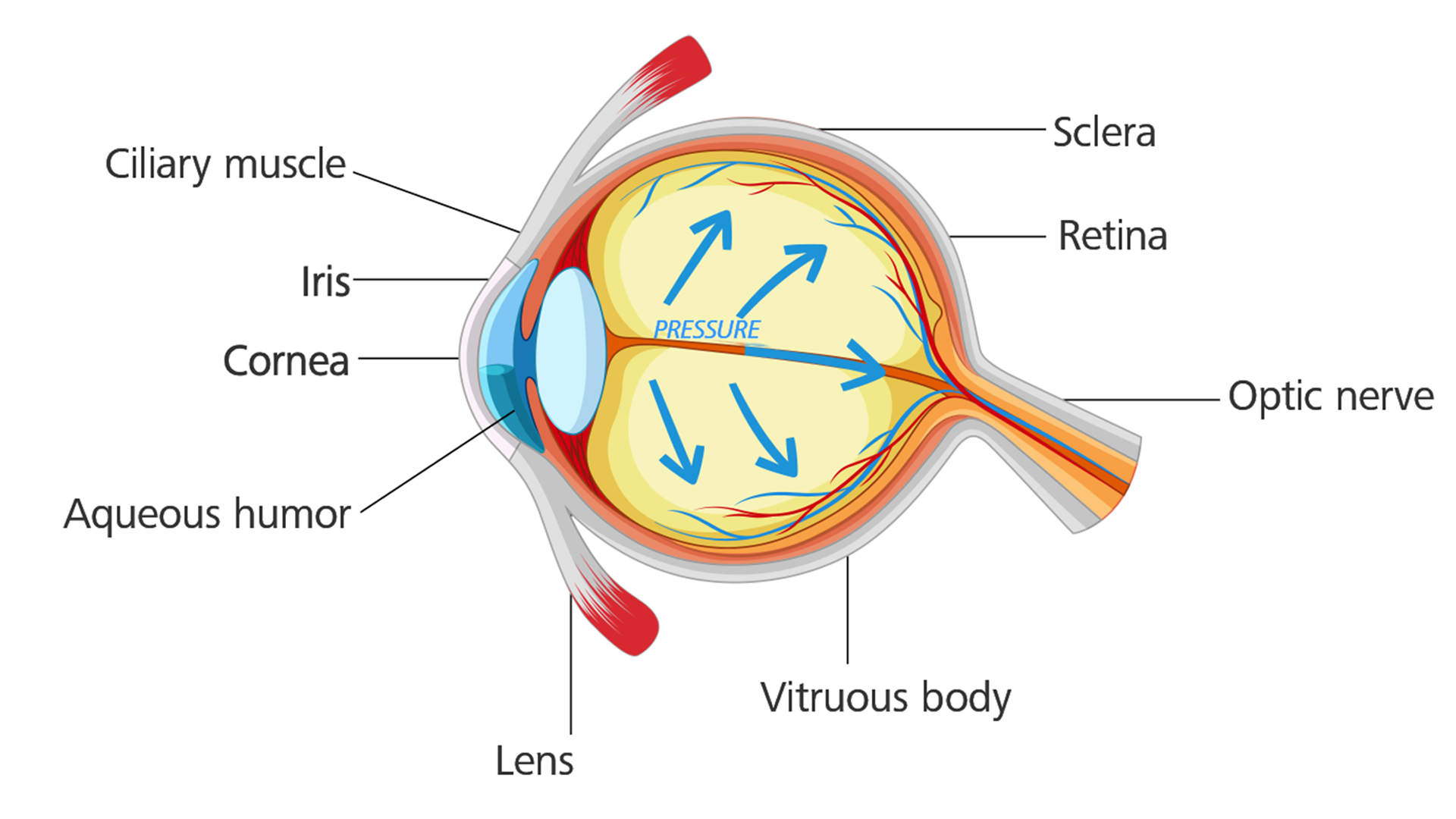 Øje med grøn stær: Øjentrykket øges og medfører en beskadigelse af den optiske nerve.