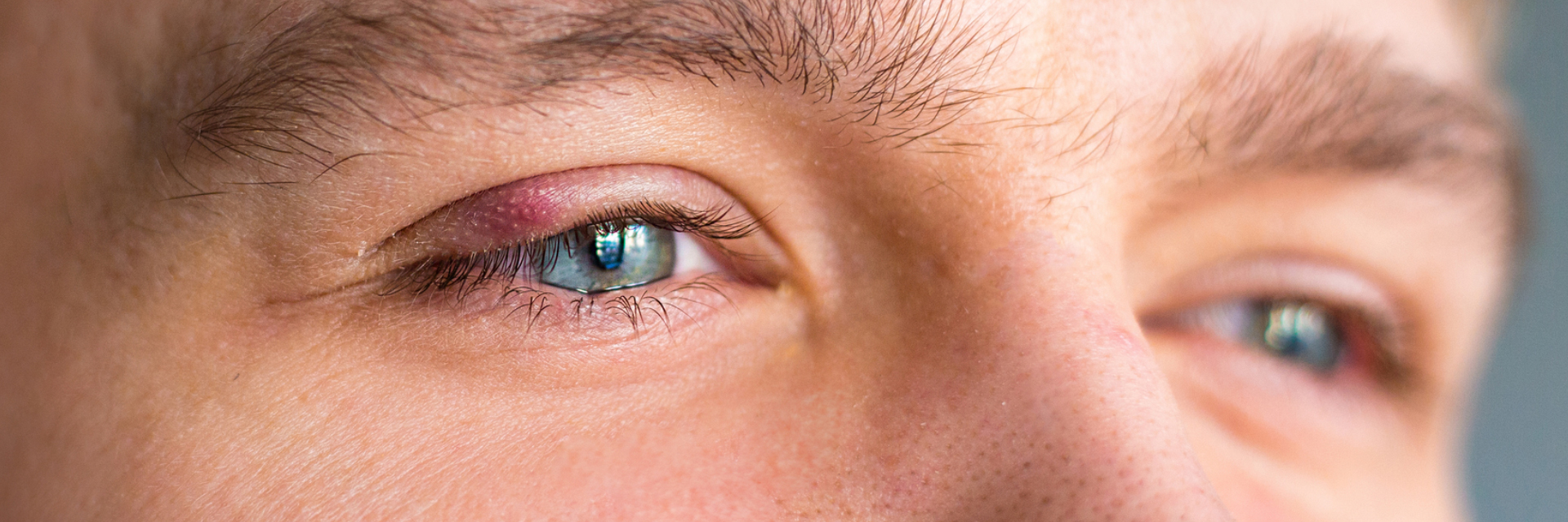 Øjenlågsbetændelse (blepharitis)