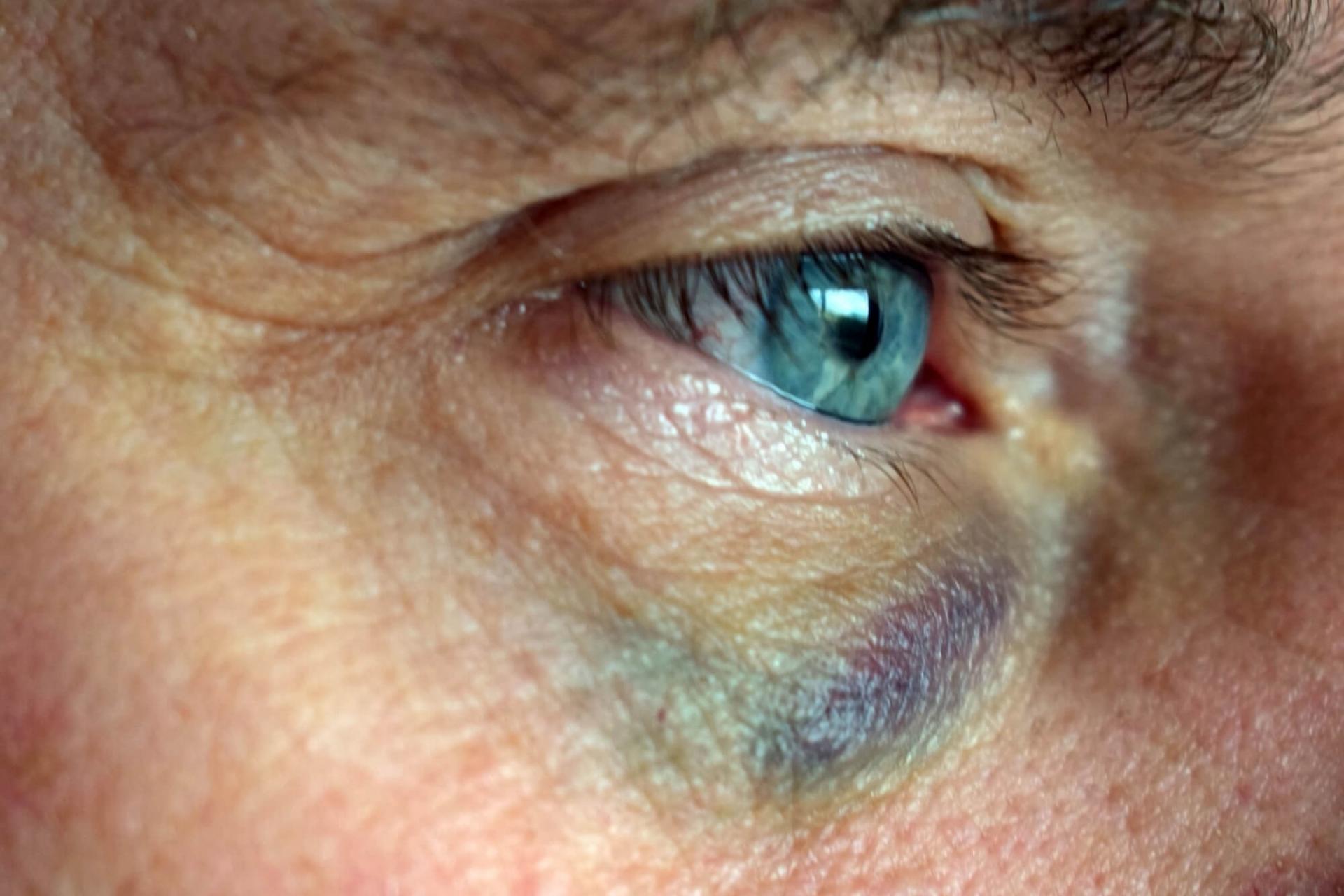 Efter et slag kan blodkar i øjet sprænge, og den hvide del af øjet (snehinden) vil fremstå rød og blodskudt.