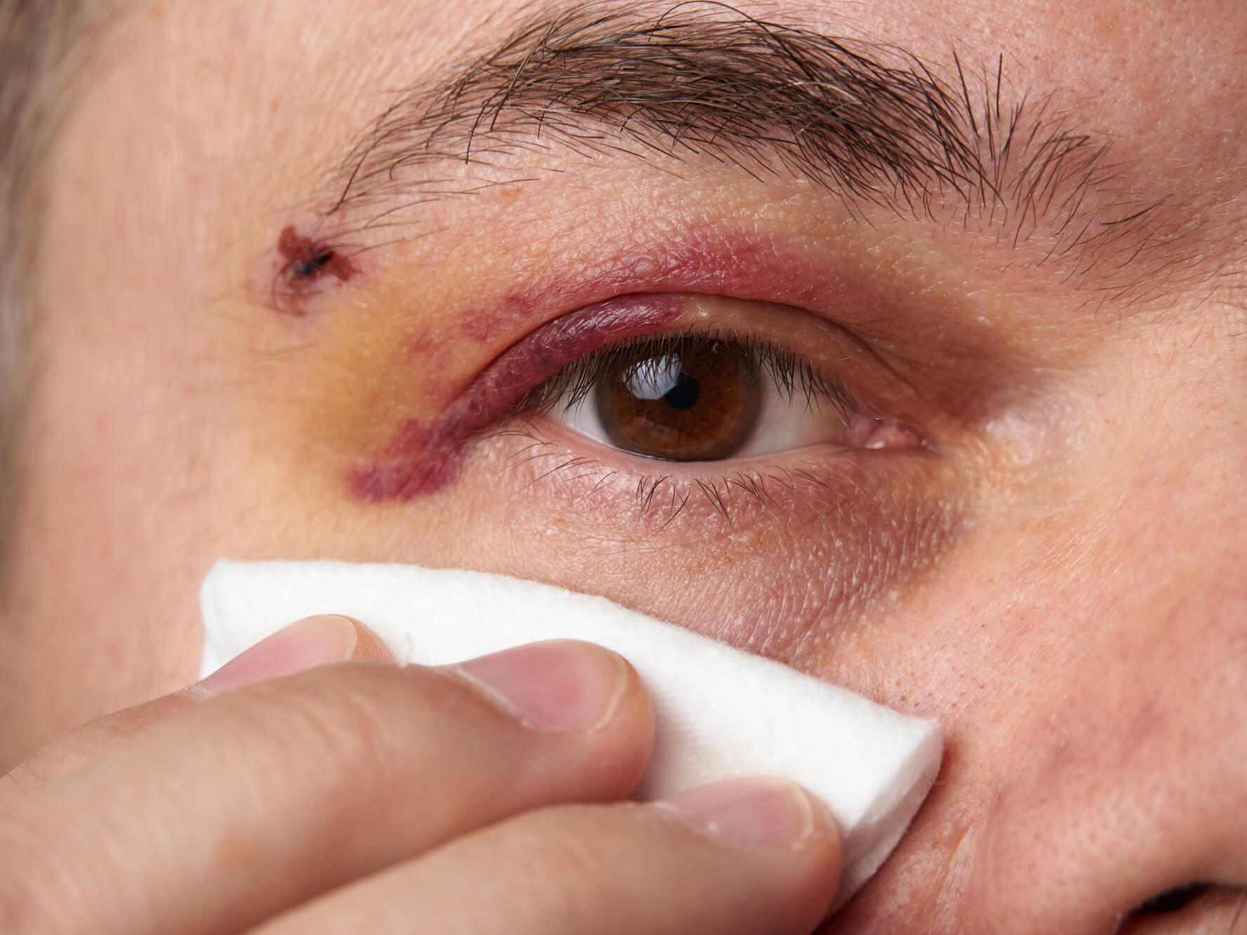 Påføring af et koldt omslag på øjenområdet umiddelbart efter en skade kan reducere hævelse og lindre smerte.