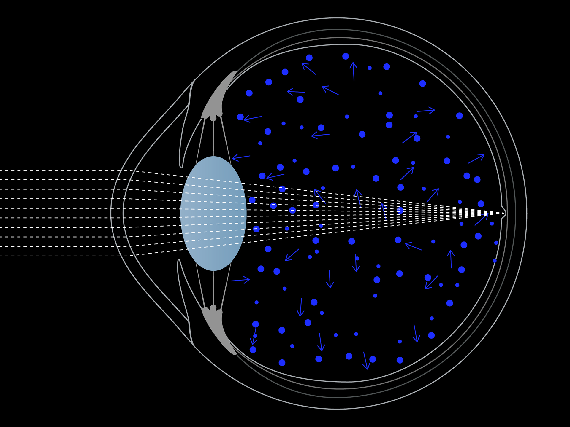 Skematisk visualisering af blålysspredning i øjet.