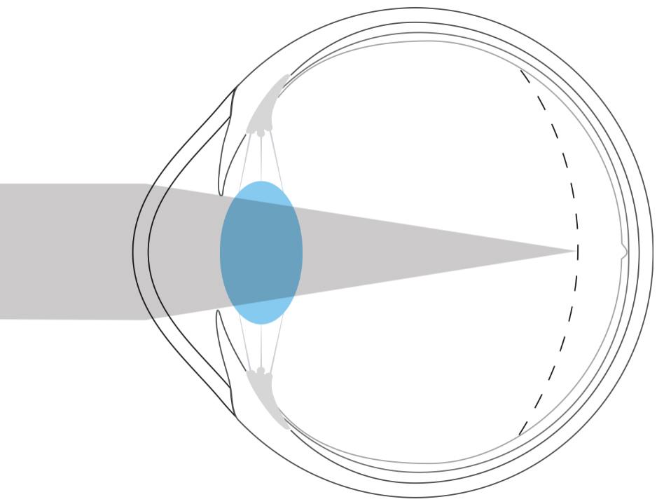 Illustration af et nærsynet øje, der viser lys fokuseret foran nethinden.