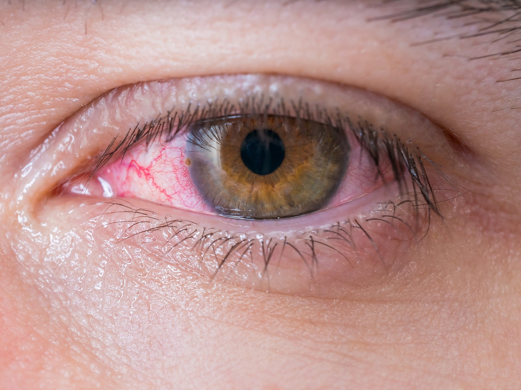 Billedet viser et usundt øje tæt på, hvor det ser ud som om der er potentielle risici for øjet. 